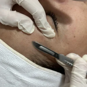 Dermaplaning