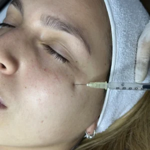 Mesoterapia Facial