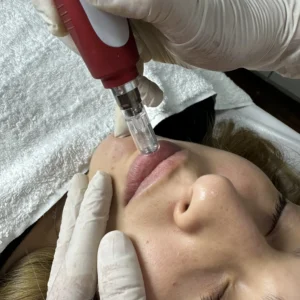 Dermapen de labios