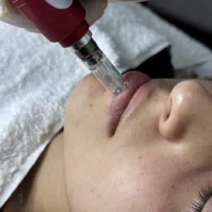 Dermapen de labios